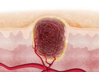 Что делать с воспалённой бородавкой