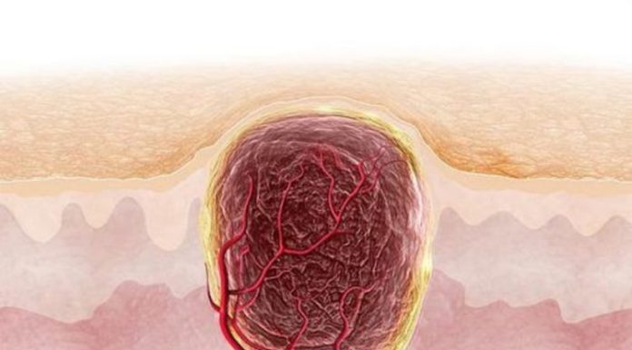 Что делать с воспалённой бородавкой