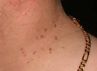 Народные методы удаления папиллом