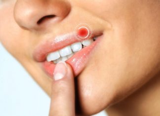 Лечение герпеса на губах в домашних условиях