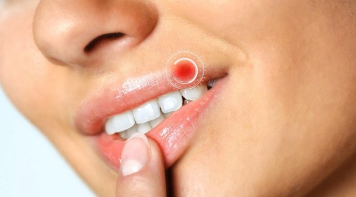 Лечение герпеса на губах в домашних условиях