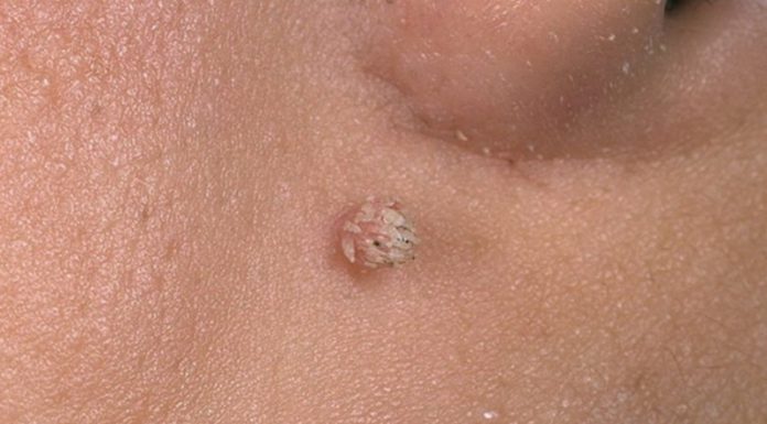 Гомеопатия от бородавок