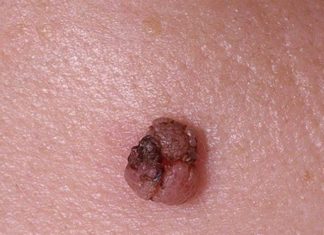 Сода против папиллом и ВПЧ