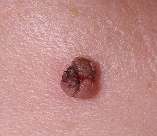 Сода против папиллом и ВПЧ