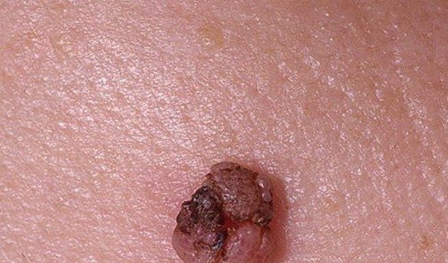 Сода против папиллом и ВПЧ