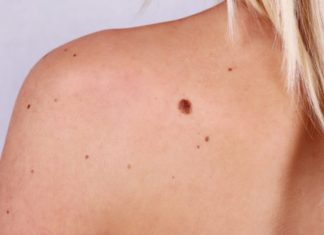 Родинки и папилломы основные отличия