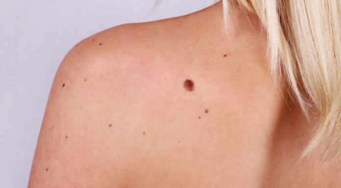 Родинки и папилломы основные отличия