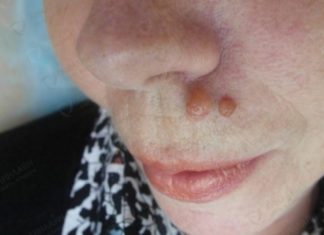 Удаление плоских бородавок на лице