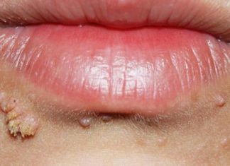 Самые лучшие способы удаления бородавок