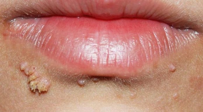 Самые лучшие способы удаления бородавок