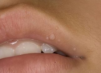 Папилломы на губах