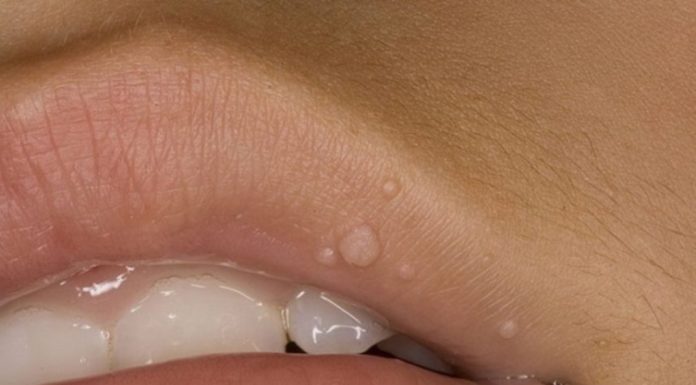 Папилломы на губах