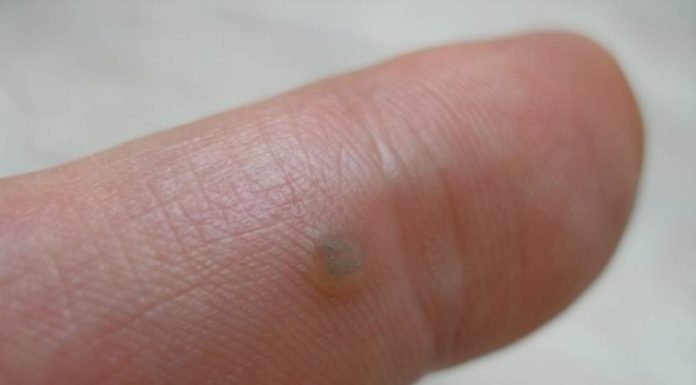 Что делать, если из бородавки идет кровь