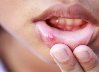 Герпес в полости рта