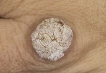 Виды бородавок