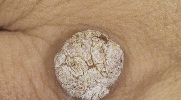 Виды бородавок