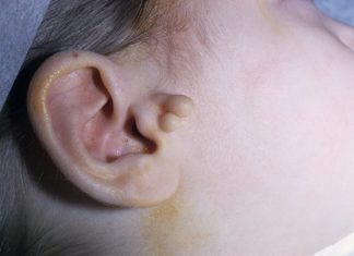 Папилломы на или в ухе