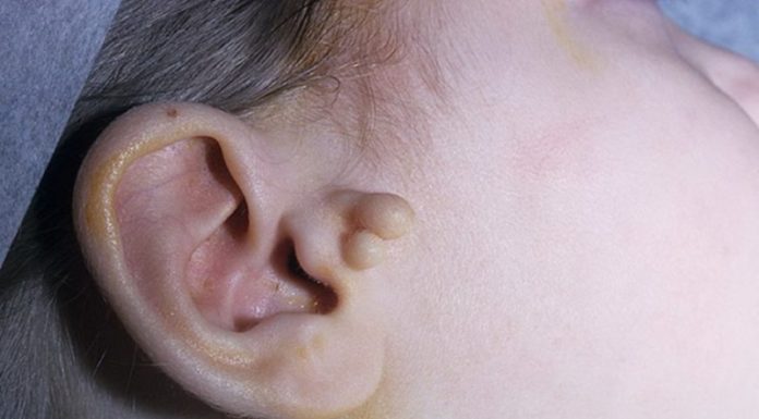 Папилломы на или в ухе