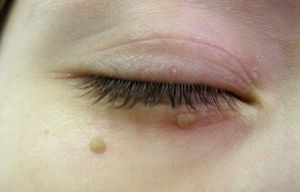 Чем отличаются папилломы от кондилом