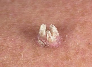 Какие бородавки нельзя удалять самому