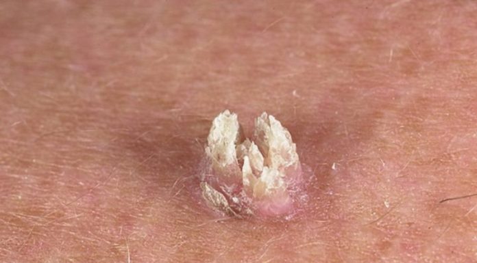 Какие бородавки нельзя удалять самому