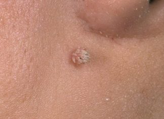 Выводим бородавку картошкой