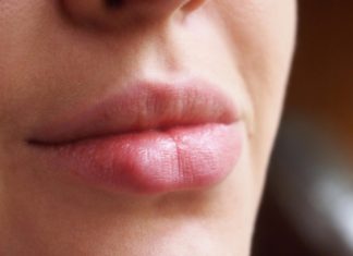 Как бороться с герпетической инфекцией на губах