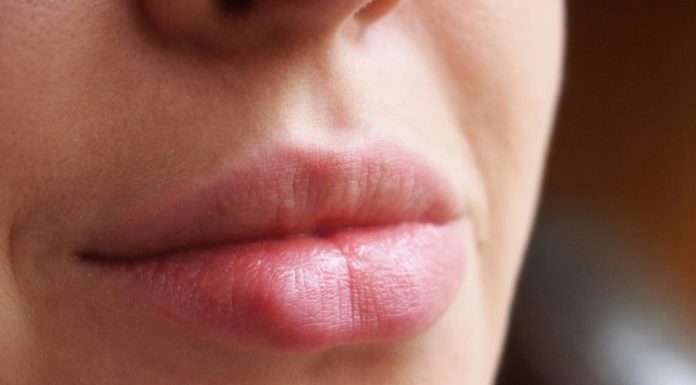 Как бороться с герпетической инфекцией на губах
