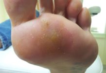 Прижигание азотом подошвенных бородавок