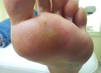 Прижигание азотом подошвенных бородавок