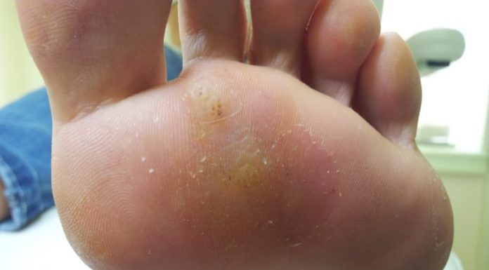 Прижигание азотом подошвенных бородавок