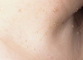 Папилломы на шее