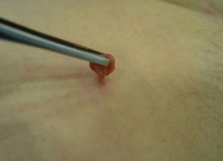 Папиллома на ножке