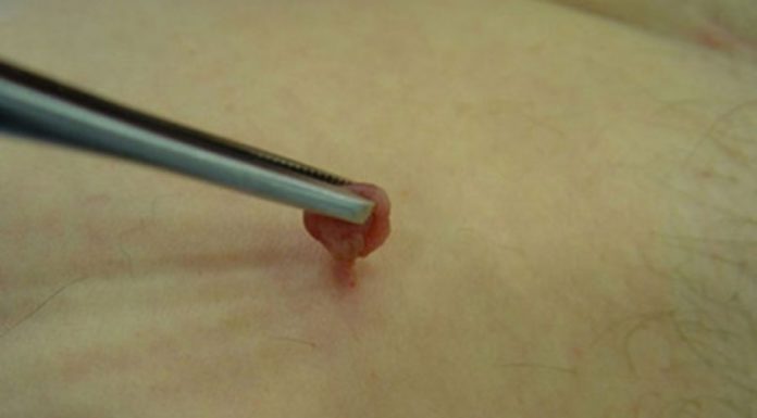 Папиллома на ножке