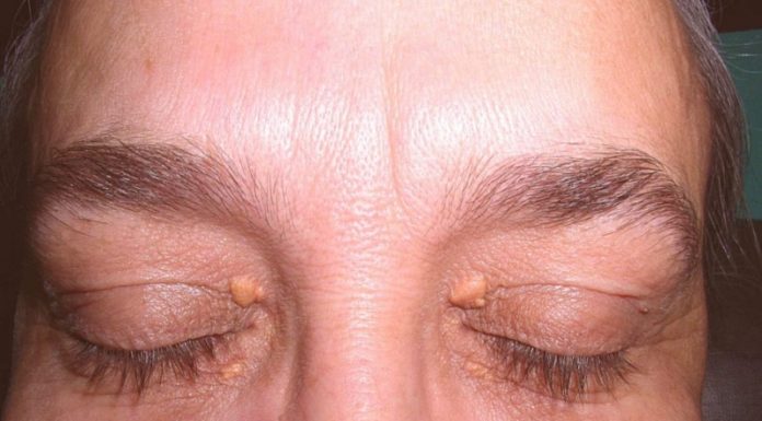Папилломы на глазах