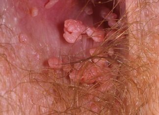 Папилломы на анусе