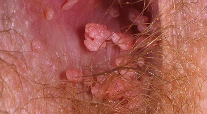 Папилломы на анусе