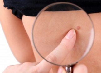 Папилломы на животе и в пупке