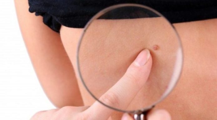 Папилломы на животе и в пупке