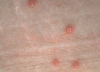 Жидкая, водянистая, мягкая бородавка