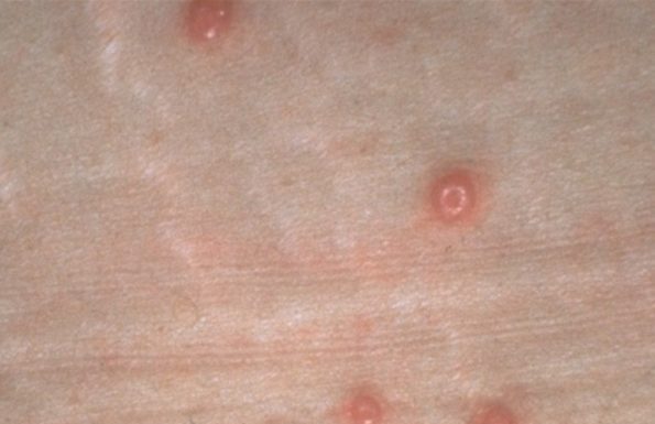 Жидкая, водянистая, мягкая бородавка