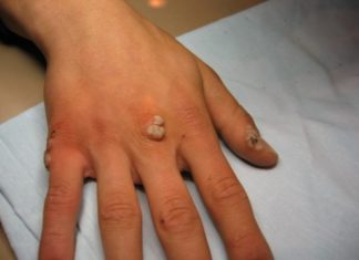 Как избавиться от бородавок на руках народными средствами