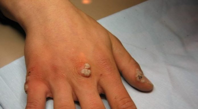 Как избавиться от бородавок на руках народными средствами