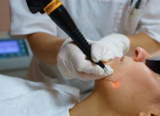 Удалять папилломы нужно!