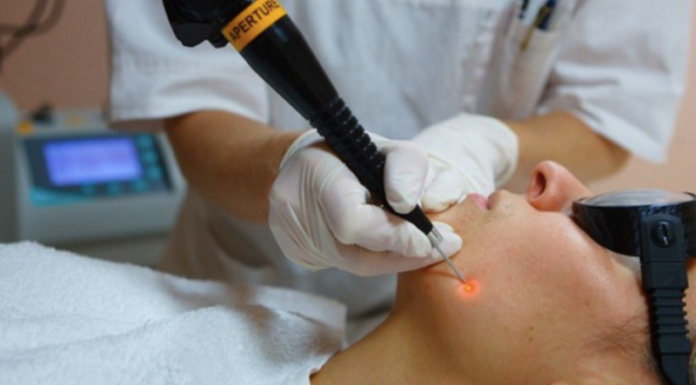 Удалять папилломы нужно!