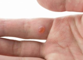 Рейтинг действенных пластырей от бородавок