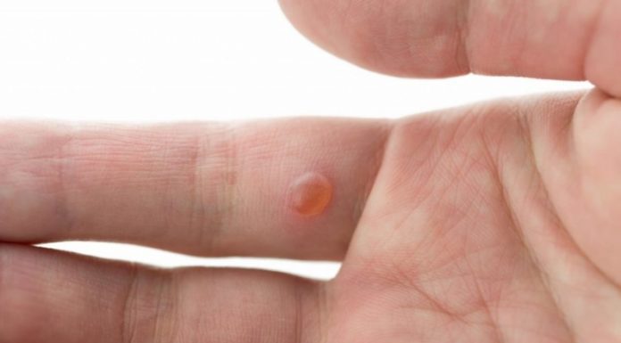 Рейтинг действенных пластырей от бородавок