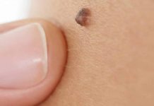 Откуда берутся папилломы на теле