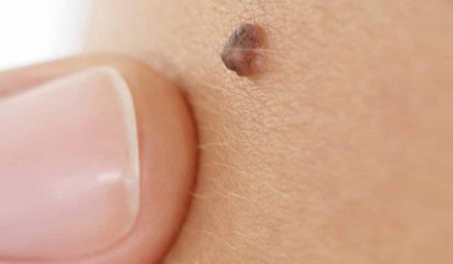 Откуда берутся папилломы на теле