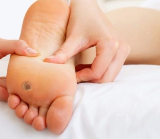 Заговоры от подошвенных бородавок